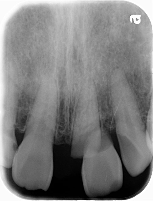 レントゲン写真