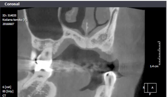 レントゲン（骨造成前）