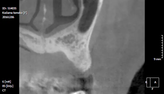 レントゲン（骨造成後）